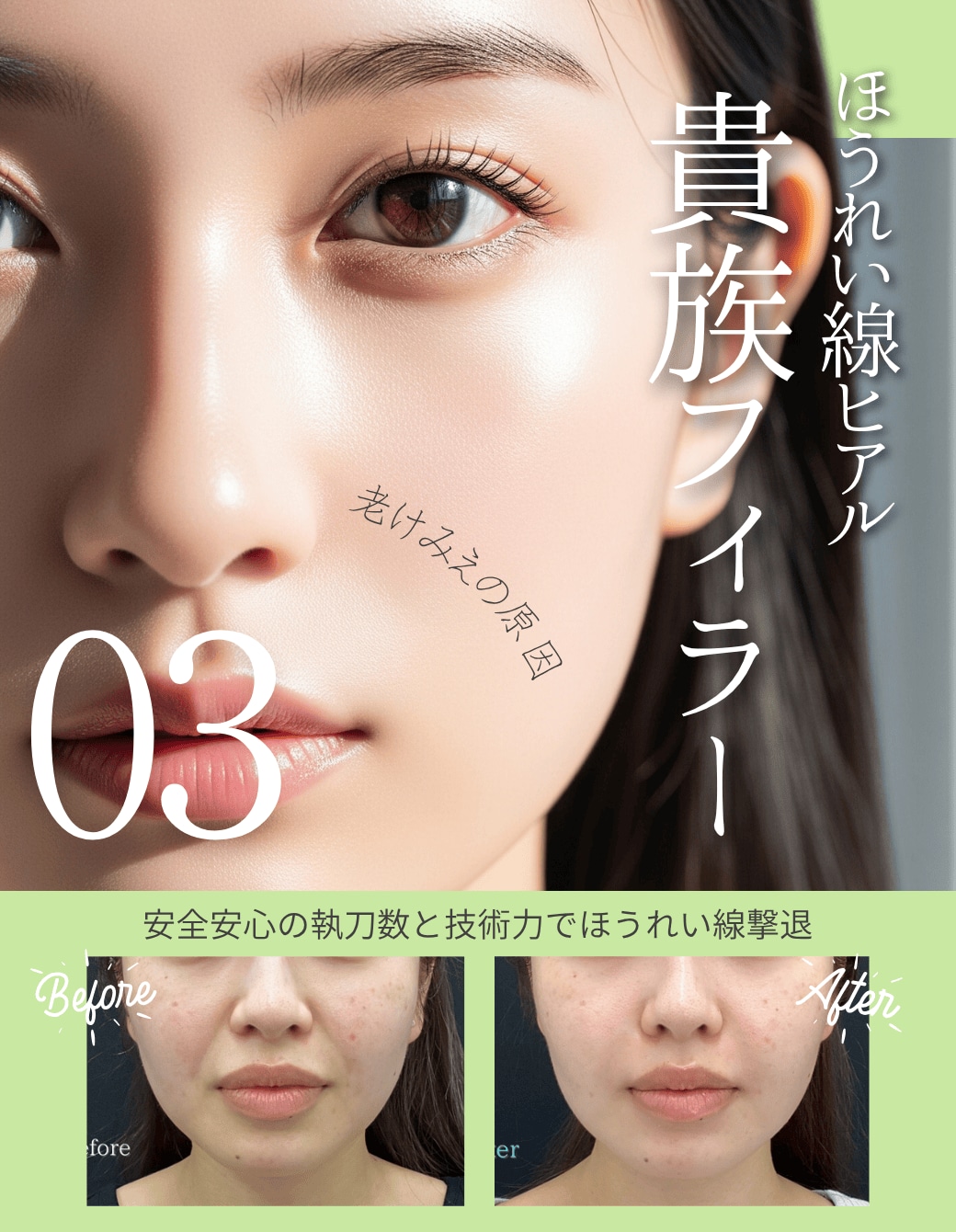 【貴族フィラー】ほうれい線を薄く目立たなくハリのあるお顔に♪